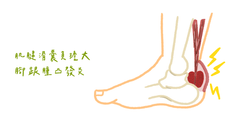 腳跟又腫又凸?物理治療師:認識哈格倫氏症候群