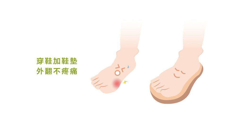 拇趾外翻嚴重嗎？該怎麼判斷？又該怎麼處理呢？ - Bestmade 人學院
